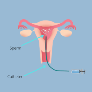 IUI Process